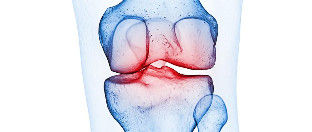 Schmerzen entstehen durch direkt aneinander reibende Knochen
