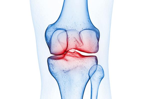 Schmerzen entstehen durch direkt aneinander reibende Knochen
